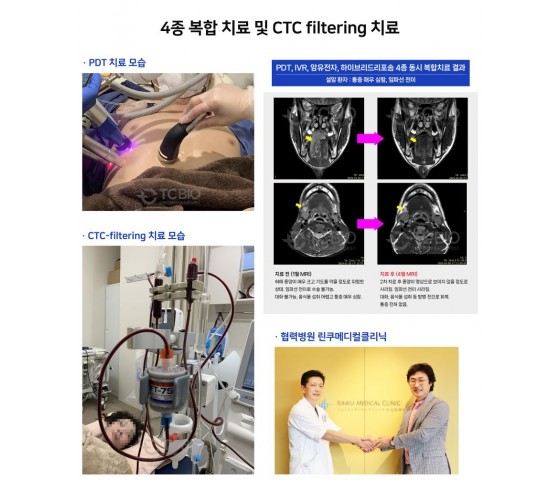 [월간암]암 수술과 중입자치료 후 잔존 암을 제거하는 CTC-filter…