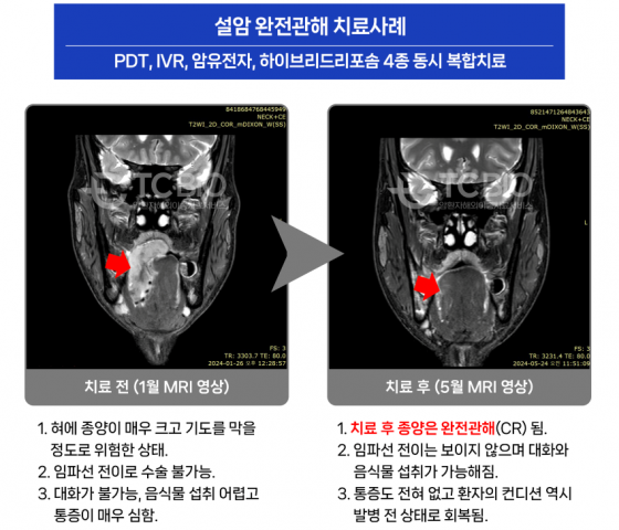 [한국미디어뉴스통신]설암 4기 환자, 4개월 만에 완전 관해 시키다'