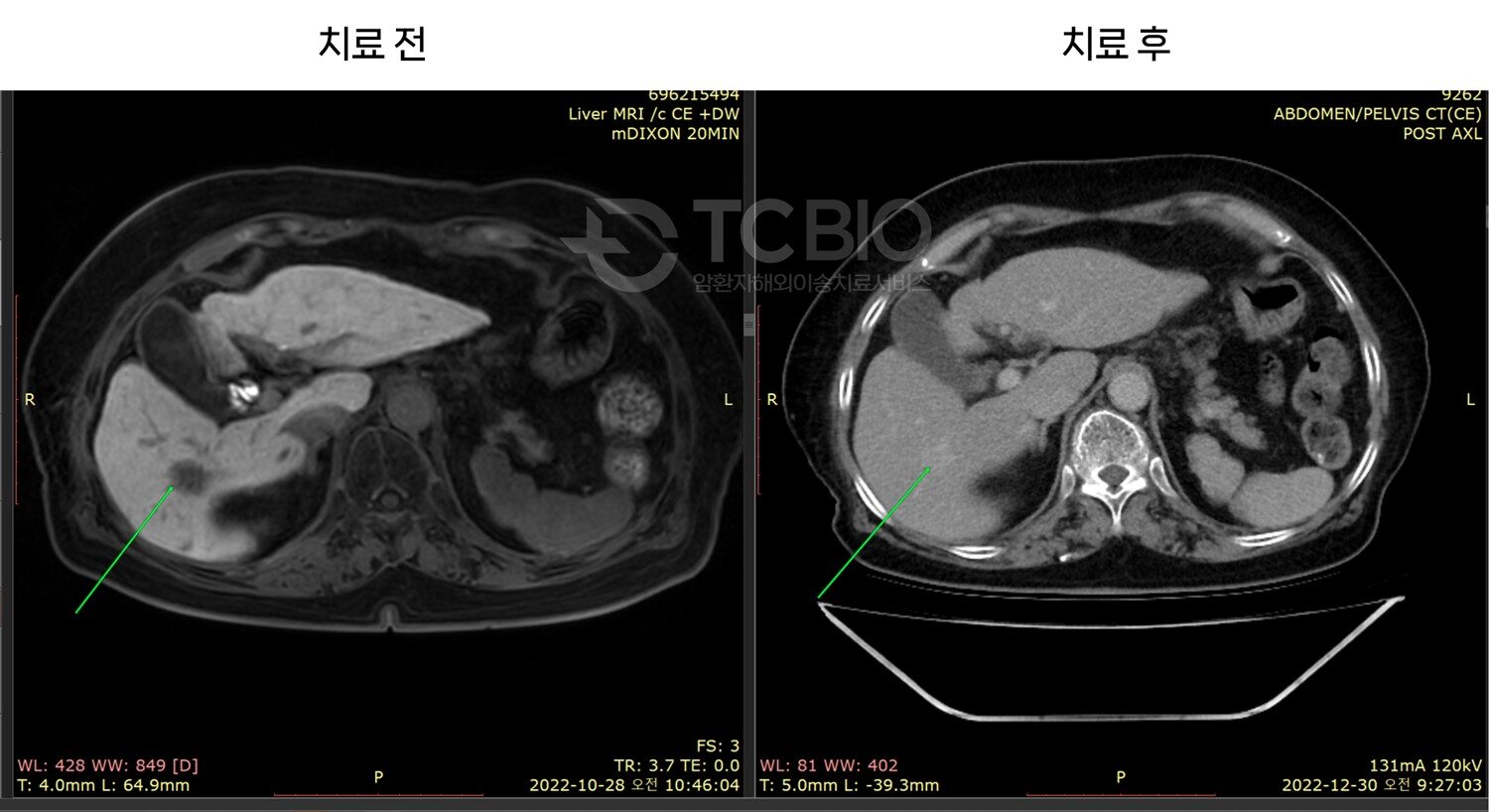 간암 사례