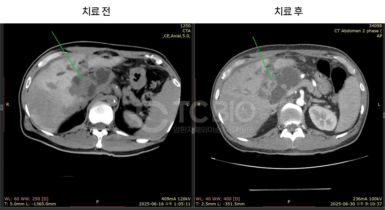 담도암 복막전이 사례