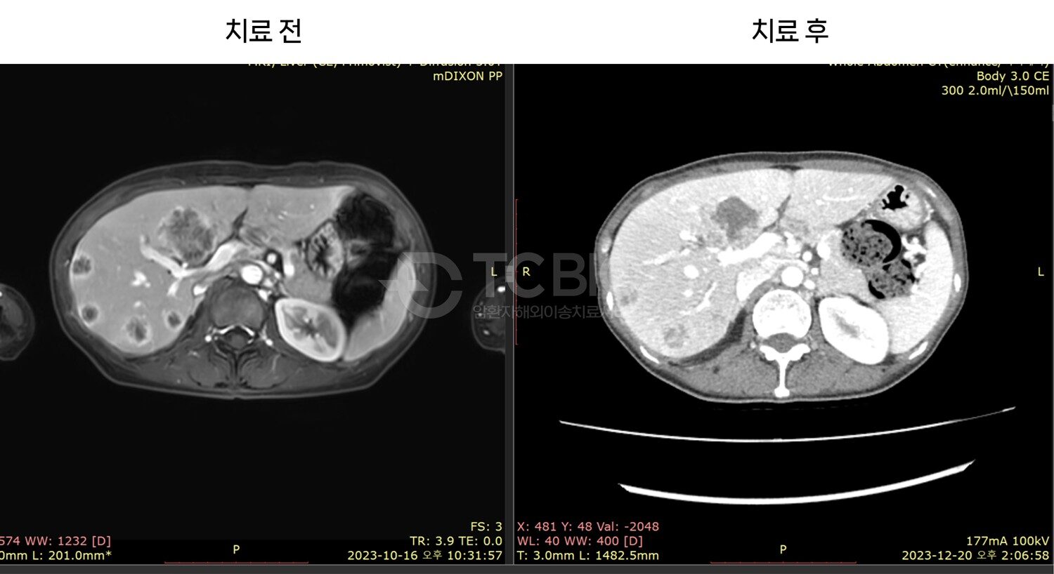 대장암 간전이 사례