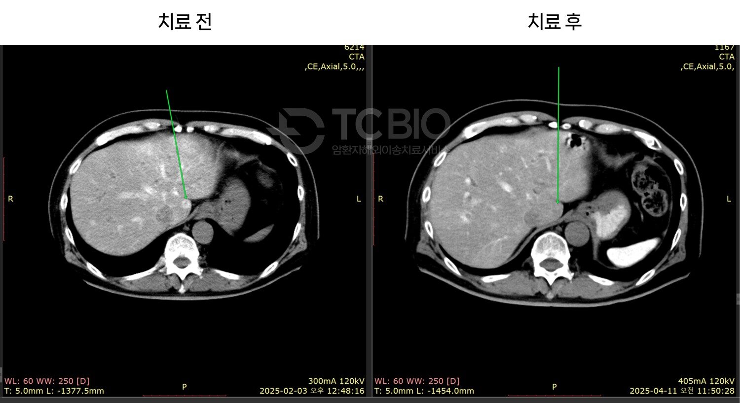 췌장암 간전이 사례