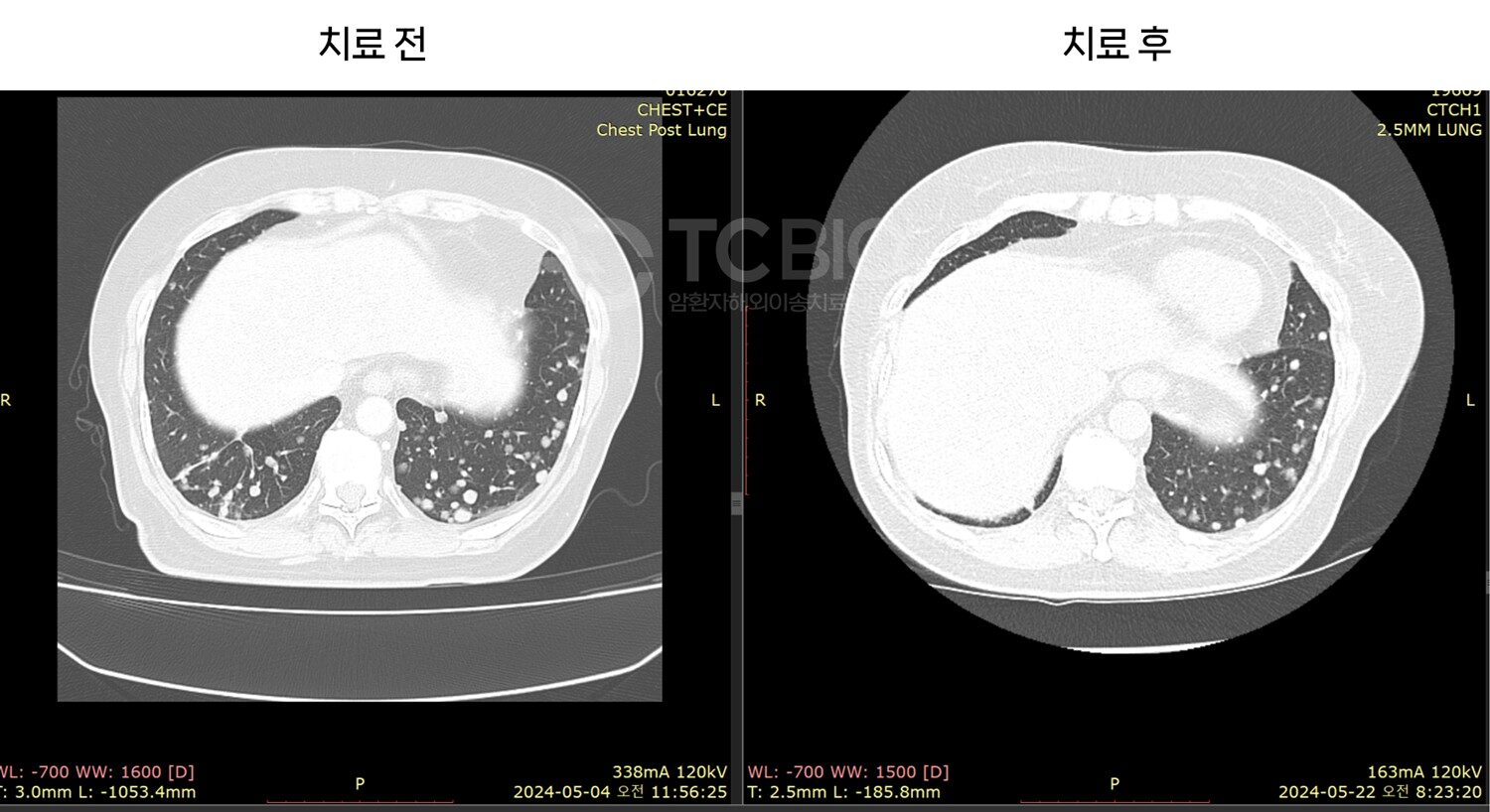폐암 림프전이 사례