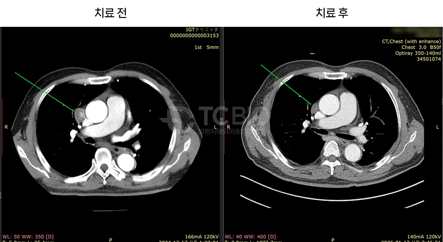 간암 종격동 전이 사례